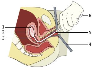 Zuigcurettage