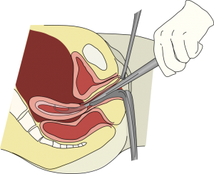Gewone curettage